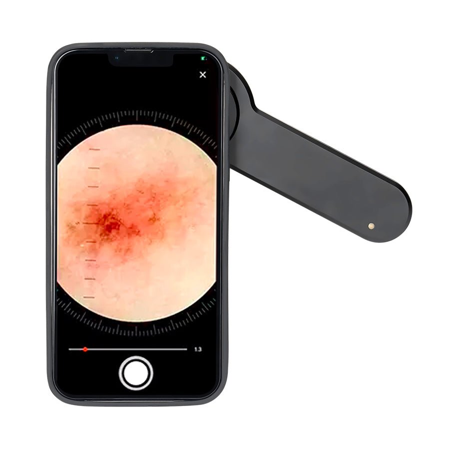 Dermatoscope DE - 3100 - Dermatoscope Plus - smartphone image view - Best dermatoscope - smartphone compatible dermatoscope - buy dermatoscope  - dermatoscope