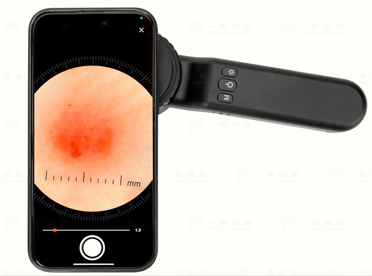 Dermatoscope DE - 4100 - Dermatoscope Plus - dermatoscope attached to smartphone image quality view - Best dermatoscope - smartphone compatible dermatoscope - buy dermatoscope - dermatoscope