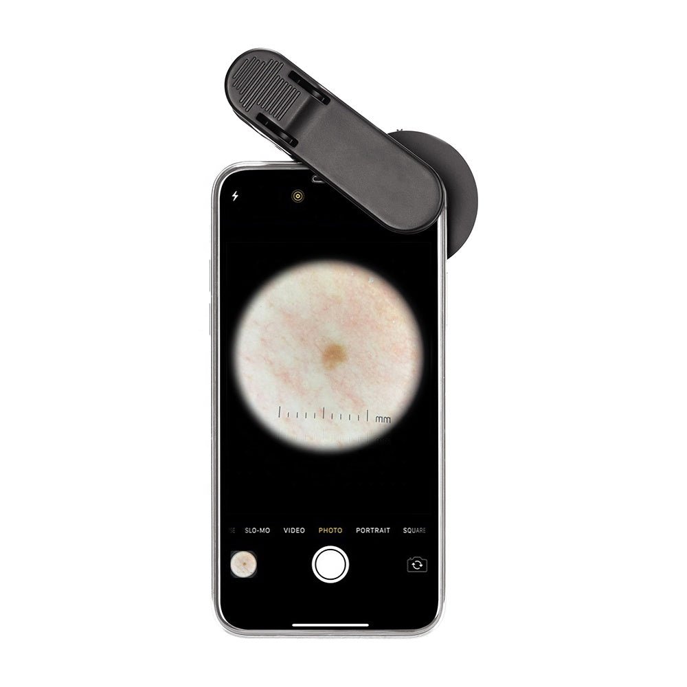 Smartphone DE - 300 Dermatoscope - Dermatoscope Plus - from smartphone inage view - Best dermatoscope - smartphone compatible dermatoscope - buy dermatoscope  - dermatoscope